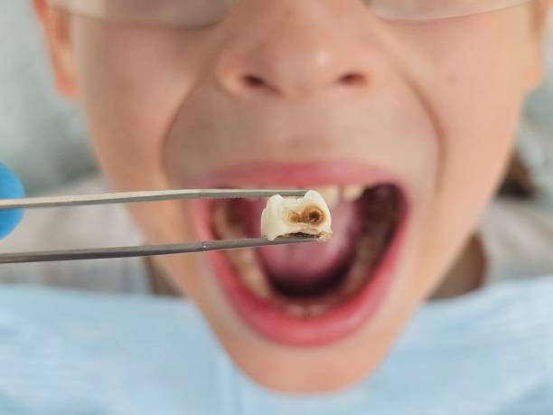 Best Emergency Dental Care for Broken or Chipped Teeth in Mccom, OH